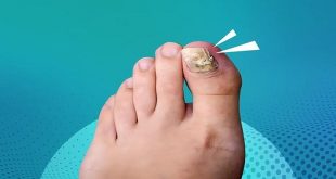 Unlocking the Secrets to Treating and Preventing Fungal Nail Infections: Expert Guide 2023