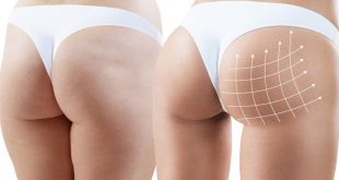 Brazilian Butt Lift Surgery in Turkey: Cost, Procedure, and Considerations