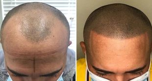 Unveiling the Magic of Scalp Micropigmentation: A Solution to Hair Loss