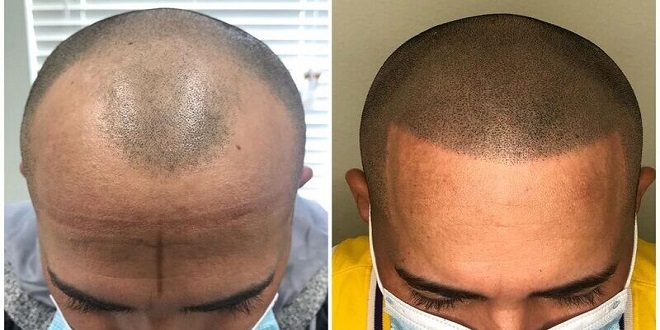 Unveiling the Magic of Scalp Micropigmentation: A Solution to Hair Loss